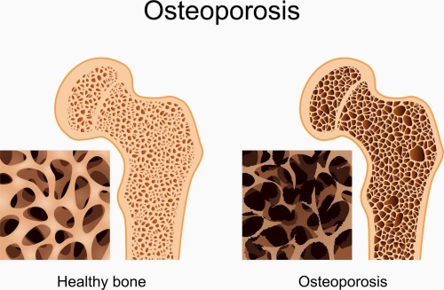  Secara umum, penyakit osteoporosis disebabkan oleh kurangnya kalsium dalam tubuh. Kalsium dapat kita peroleh melalui berbagai macam makanan yang kita konsumsi dalam kehidupan sehari-hari. 