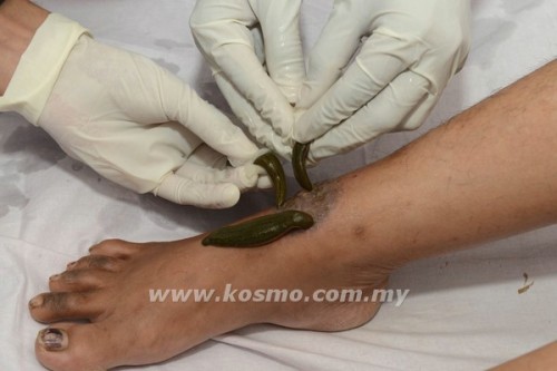 Tiga ekor lintah gemuk ditempelkan ke kaki pasien, sebagai bagian dari Jaluka Avacharan alias terapi lintah. AFP PHOTO / Sam PANTHAKY.