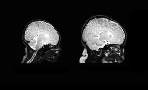 Scan otak di sebelah kiri diambil dari bayi yang baru lahir, dan satu di sebelah kanan diambil 90 hari kemudian. Kredit: Dominic Holland et al, University of California, San Diego School of Medicine.